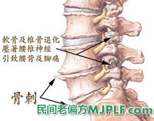 三个有效中药偏方治疗骨质增生