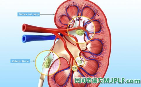 适当补钙预防肾结石复发偏方