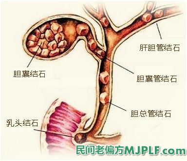 五个有效偏方治疗胆结石