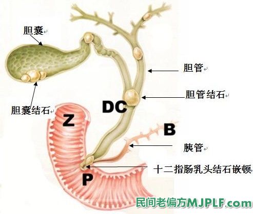 五个食疗偏方治慢性胆囊炎