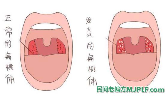 治疗扁桃体发炎偏方有效老偏方