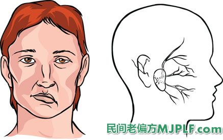 民间治疗面瘫有效偏方汇总