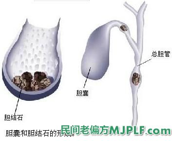 四个中药偏方治疗治慢性胆囊炎