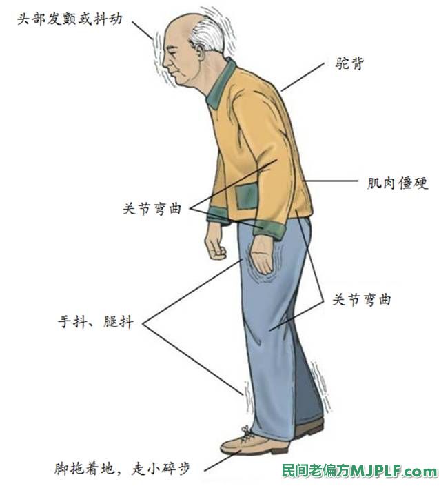 两个小偏方治疗帕金森病有奇效