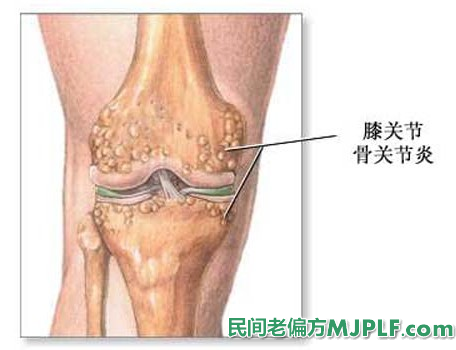 五个食疗偏方治疗骨质增生