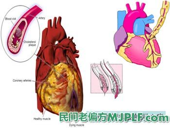 治疗冠心病最佳民间小偏方