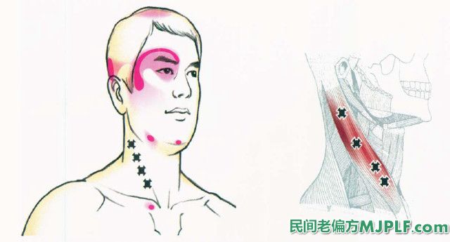 根治偏头痛中药偏方大全