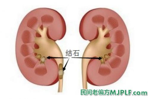 治疗泌尿系统结石食疗偏方