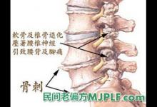 三个有效中药偏方治疗骨质增生