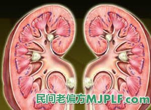 肾结石偏方